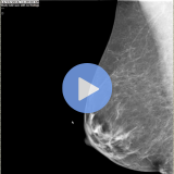 Practical Application of AI in Breast Imaging