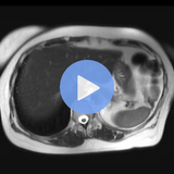 Benign Liver Lesions