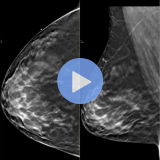 BreastTomoDBT - 2024