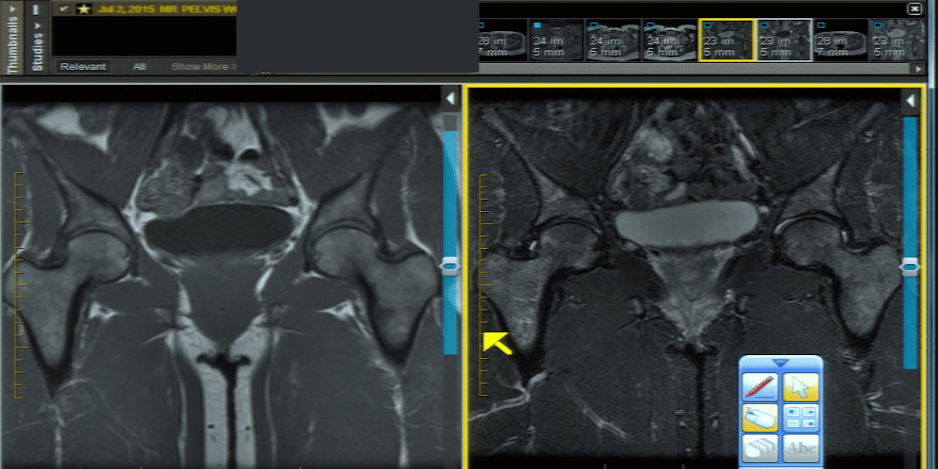 Hip MRI case