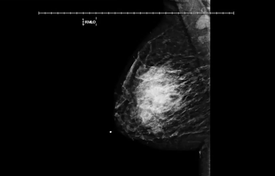 Breast imaging case