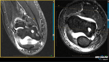 COW_C48_Elbow_PedsMSK