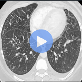 Cardiopulmonary Pattern Recognition