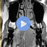 Head & Neck Squamous Cell Malignancy on MRI