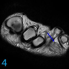 Foot & Ankle MRI Cases