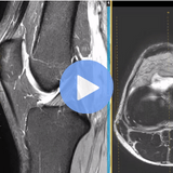 MRI of Knee 