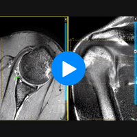 Shoulder MRI