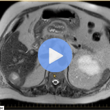 Malignant Liver Lesions on MRI