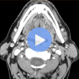 Oral Cavity and Oropharynx