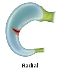 radial
