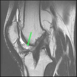 sagittal t2 fse