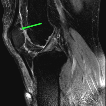 sagittal pdw spair