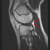 sagittal t2 fse
