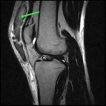 sagittal fse t2
