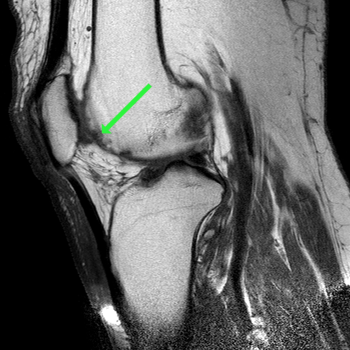 sagittal t1w tse