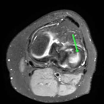 rapid axial pd isofse fat sat (0.8mm)