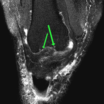 coronal t2w spair