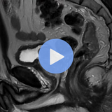 Rectal Cancer MRI