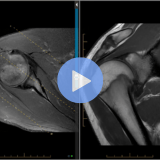 Upper Extremities: Shoulder