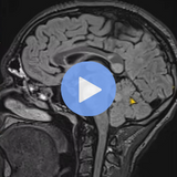 White Matter Disease