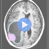 brain tumors mri