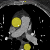 cardiac ct fundamentals-1