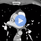 cardiac ct in known cad
