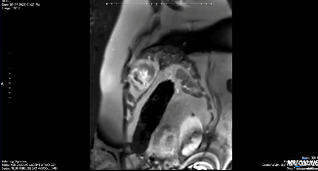cardiac mri of ischemic