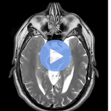 Advanced Dementia Imaging (MRI, AI, & PET)