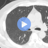 Fundamentals of Lung Cancer Screening