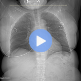 Lung Cancer Screening CT