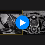 Prostate MRI